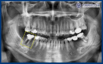 곡반정동임플란트