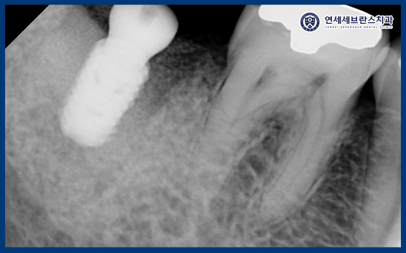 곡반정동임플란트