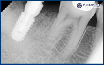 곡반정동임플란트