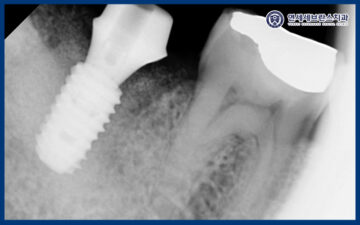 곡반정동임플란트