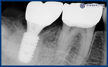 곡반정동임플란트