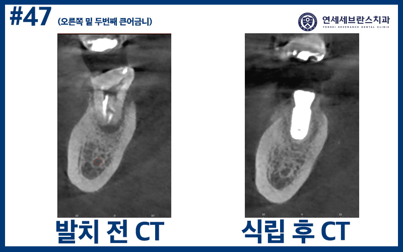 곡반정동임플란트