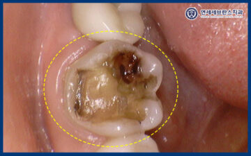 곡반정동임플란트