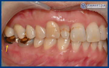 곡반정동임플란트