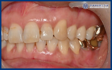 곡반정동임플란트