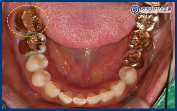 곡반정동임플란트