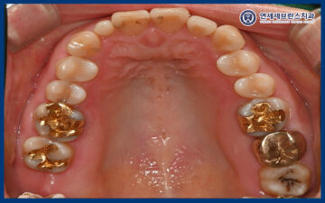 곡반정동임플란트