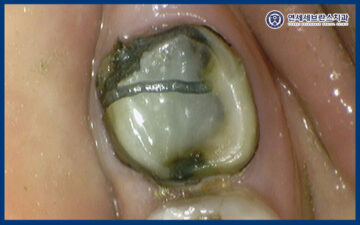 곡반정동임플란트