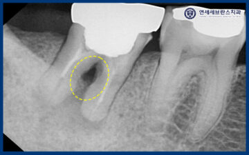 곡반정동임플란트