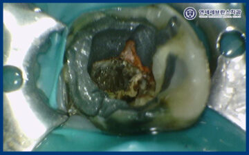 곡반정동임플란트