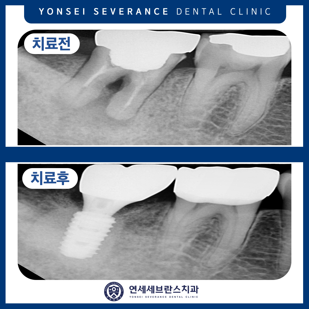 곡반정동임플란트