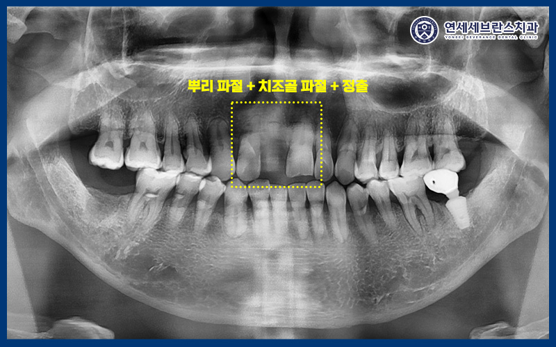 권선구임플란트