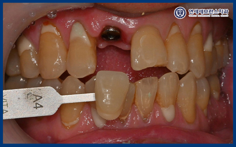권선구임플란트