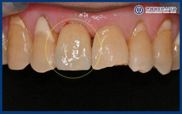 권선구임플란트
