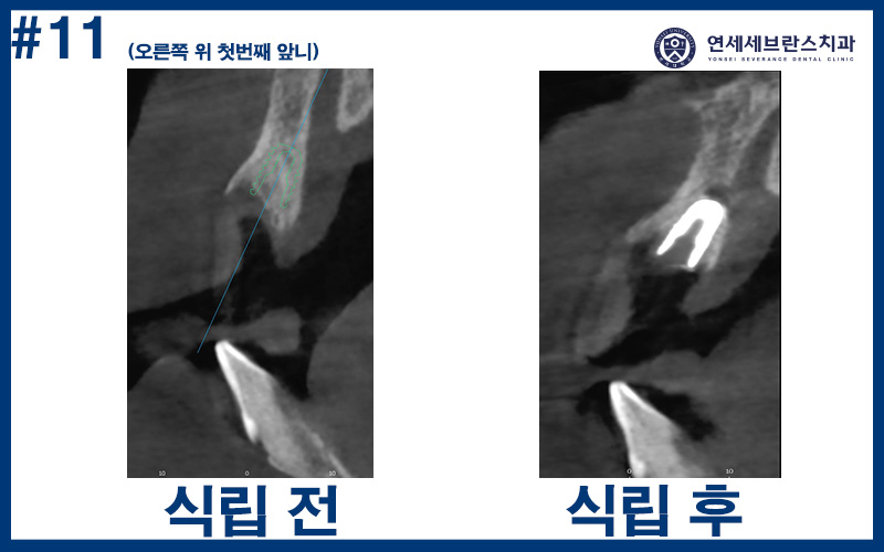 권선구임플란트