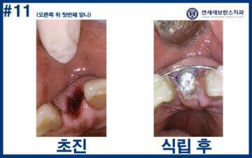권선구임플란트