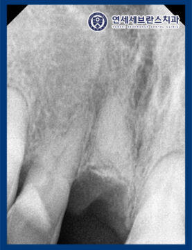 권선구임플란트