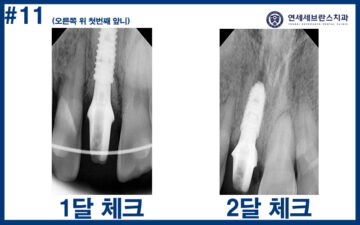 권선구임플란트