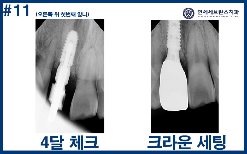 권선구임플란트