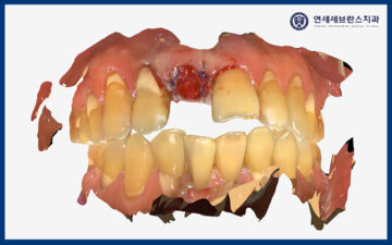 권선구임플란트