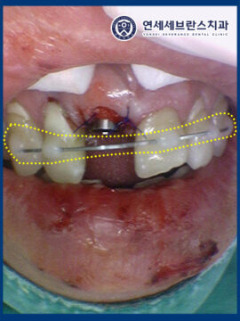 권선구임플란트