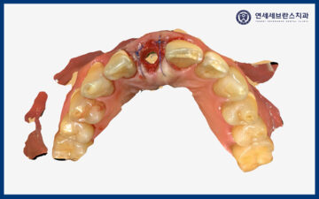 권선구임플란트