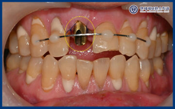 권선구임플란트