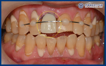 권선구임플란트