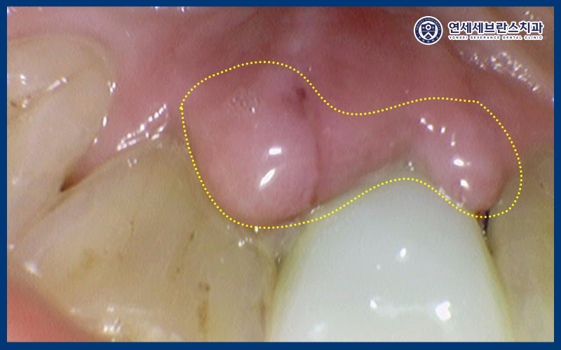 권선구임플란트