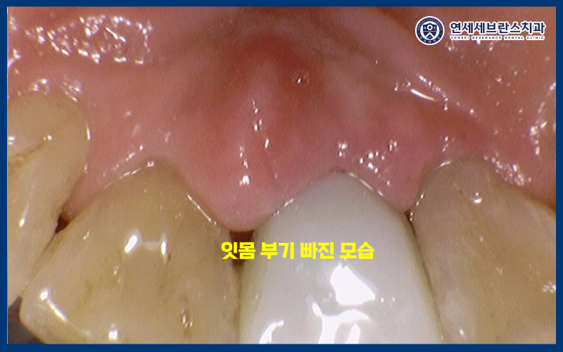 권선구임플란트