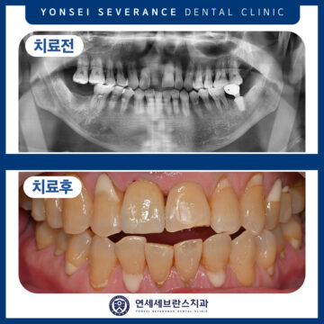 권선구임플란트