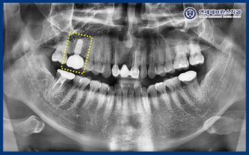 곡반정동임플란트