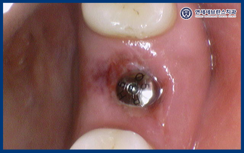 곡반정동임플란트