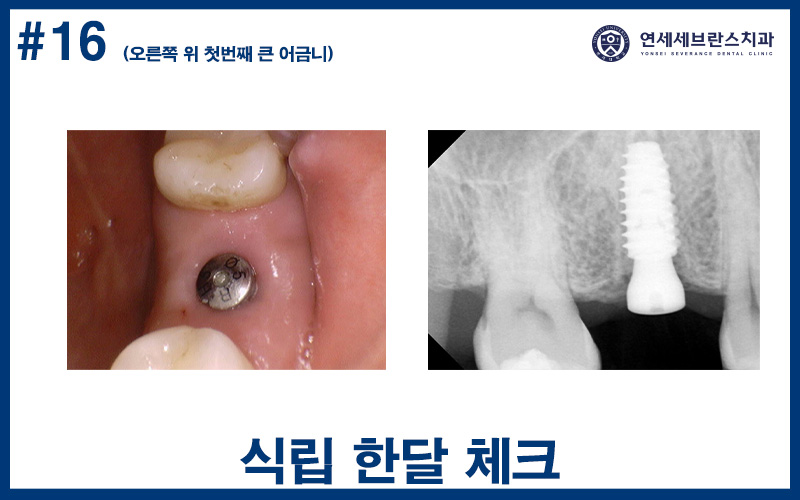 곡반정동임플란트