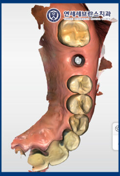 곡반정동임플란트