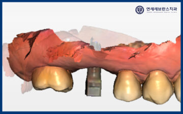 곡반정동임플란트