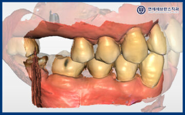 곡반정동임플란트