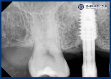 곡반정동임플란트