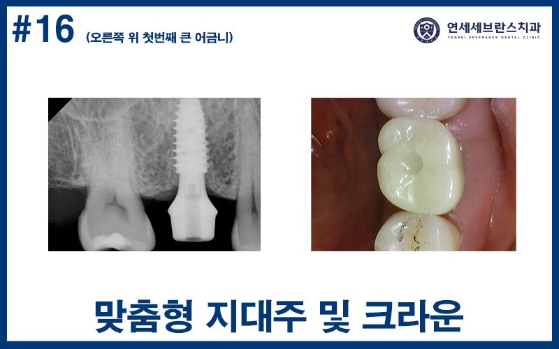 곡반정동임플란트