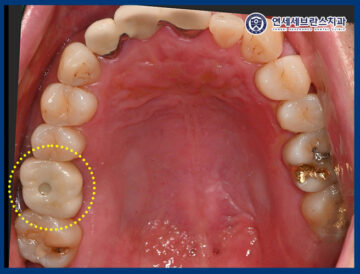 곡반정동임플란트