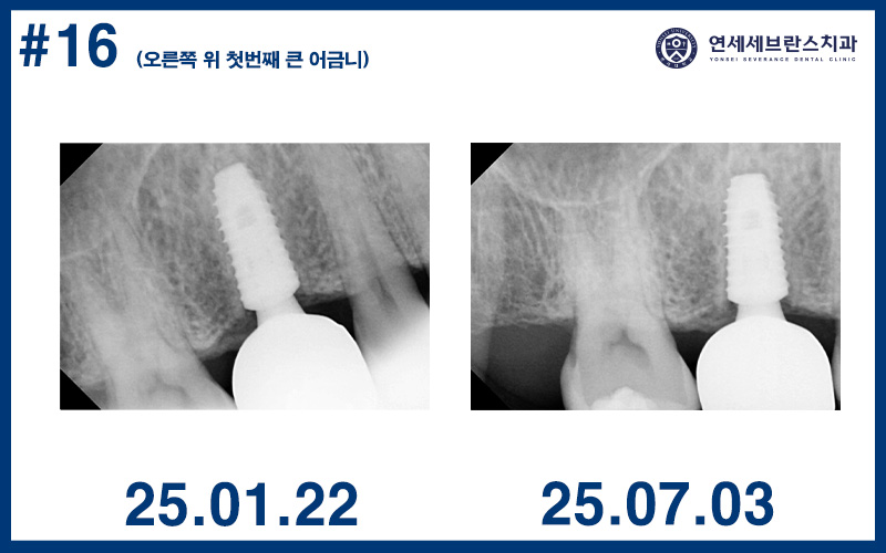 곡반정동임플란트