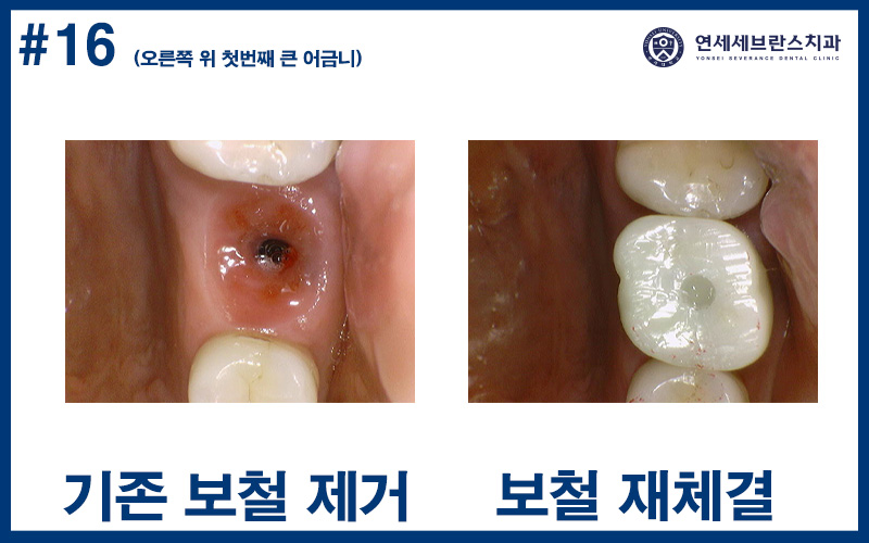 곡반정동임플란트