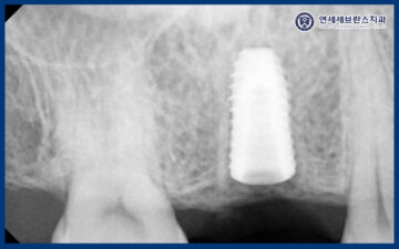 곡반정동임플란트