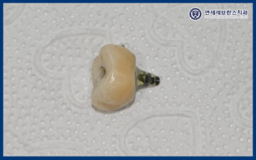 곡반정동임플란트