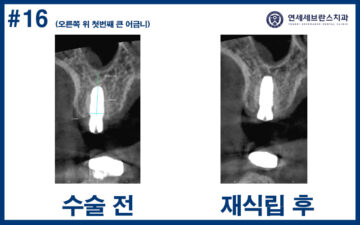곡반정동임플란트
