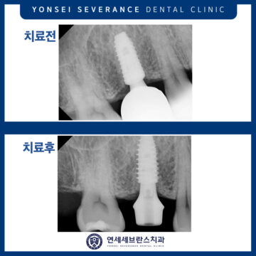 곡반정동임플란트