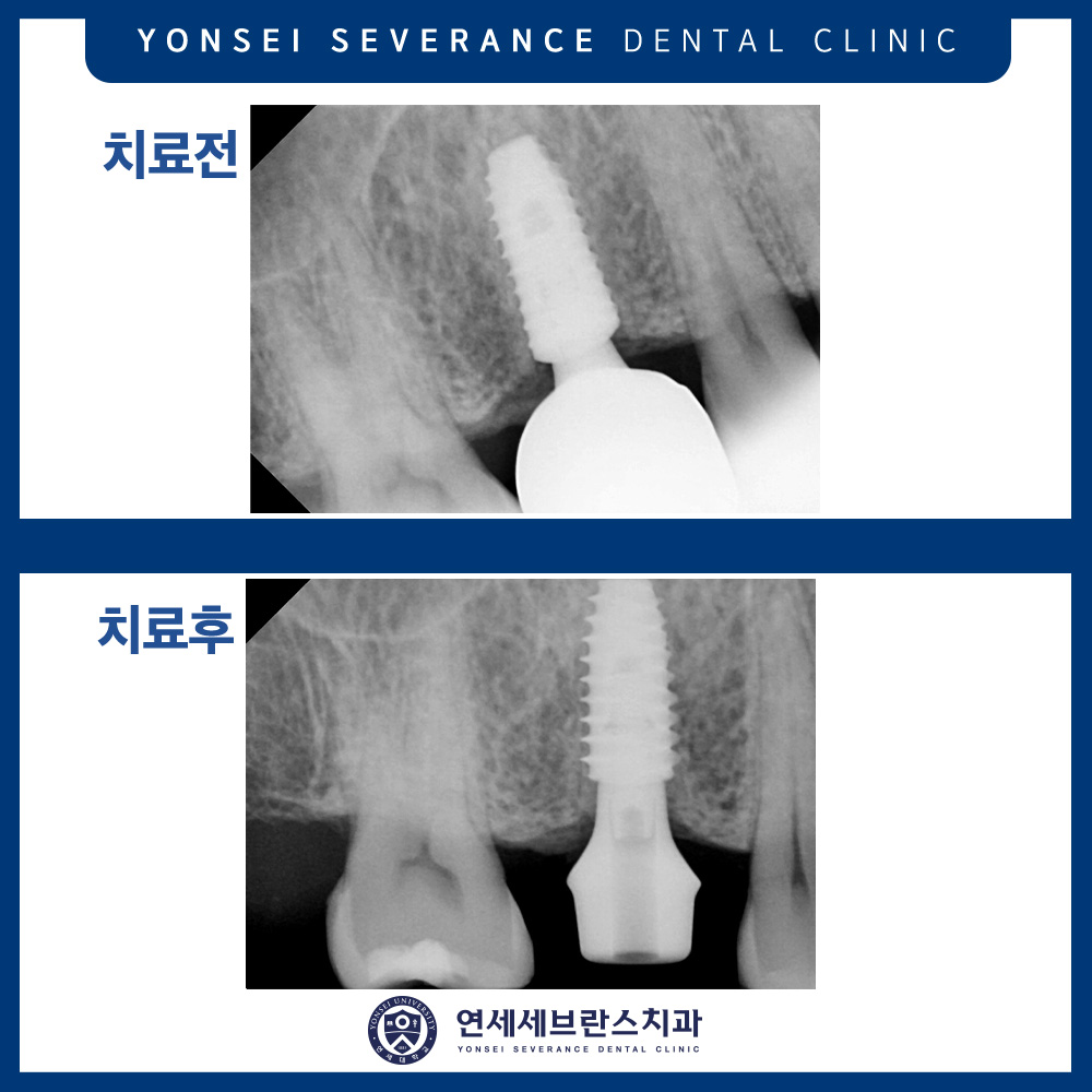 곡반정동임플란트