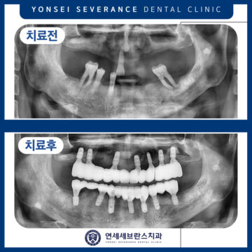 권선구임플란트