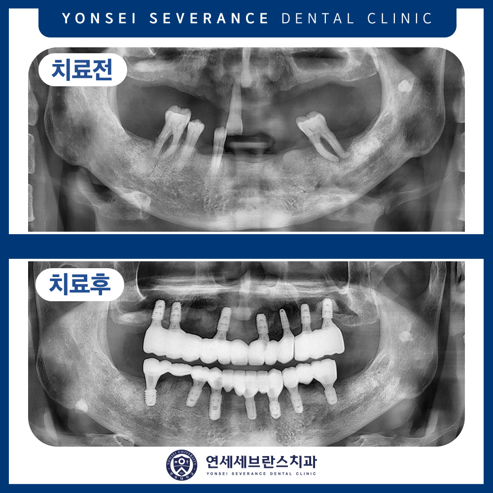 권선구임플란트